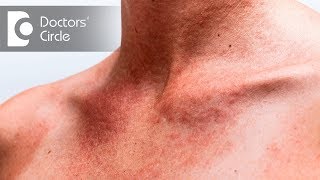 How to avoid and treat Summer Rashes and Stings  Dr Rajdeep Mysore [upl. by Eeldarb]