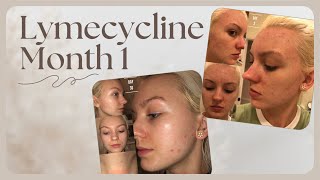 ACNE MONTH 1 ON LYMECYCLINE [upl. by Popelka]