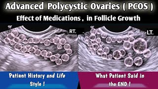 Ultrasound Polycystic Ovaries PCOS  Follicle Development after Medications [upl. by Converse]