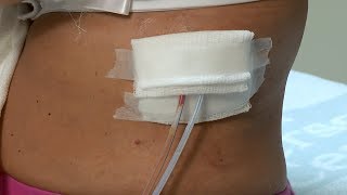 How to care for a postsurgery wound drainage system and gauze dressing [upl. by Ciro367]