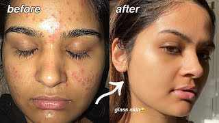 how i cleared my acne FOR GOOD something finally worked [upl. by Ardith]