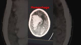 Ct scan hemorrhage ctbrain ctscan hemorrhage bloodpressure hypertension blood head cthead [upl. by Ahsinak]