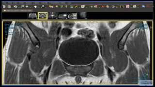 Hip Avulsion Fracture of the Anterior Inferior Iliac Spine [upl. by Anastassia911]