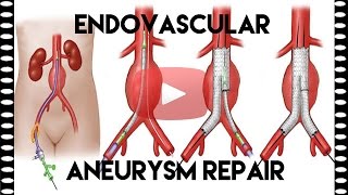 What is EVAR or Endovascular Aneurysm Repair  Medical Coding Tips [upl. by Pevzner]