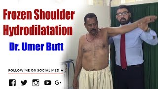 Hydrodilatation For Frozen Shoulder  Frozen Shoulder Treatments By Dr Umer Butt Orthopedic Surgeon [upl. by Lebaron]