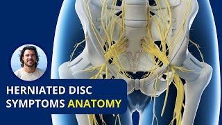 Herniated Disc Bulging Disc Paralysis  Lower Back Pain [upl. by Emad961]