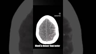 Haemorrhagic Stroke [upl. by Earal]