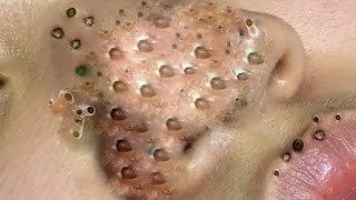 Big Cystic Acne Blackheads Extraction Blackheads amp Milia Whiteheads Removal Pimple Popping  2474 [upl. by Yellat540]