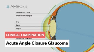 Acute Angle Closure Glaucoma [upl. by Parks]