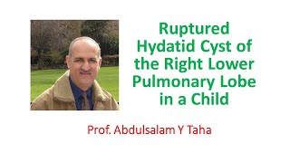 Ruptured Hydatid Cyst of the Right Lower Pulmonary Lobe in a Child [upl. by Hanahs]