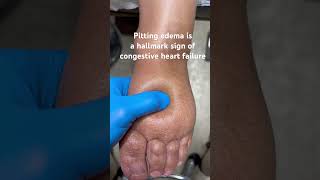 Pitting Edema Is A Sign Of Congestive Heart Failure [upl. by Latsyek177]