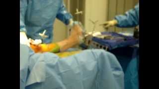 Intraoperative varusvalgus knee stability testing [upl. by Ardnasac]