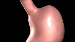 Gastric Bypass animation [upl. by Zwick]