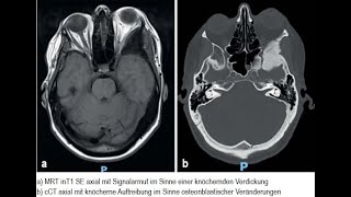 Osteodystrophia deformans Paget mit einseitigem Exophthalmus [upl. by Krischer]