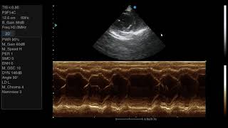 EkokardiyografiIII Sağ Parasternal Kısa Eksen Mitral Kapak Seviyesi [upl. by Alim]
