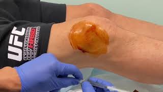 MoraMD Knee Effusion Aspiration A Nearly Painless Technique [upl. by Revilo]