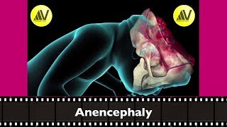 Anencephaly Explained [upl. by Purity]