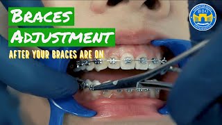 How Do Braces Straighten Teeth [upl. by Claudette]