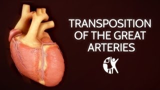 Transposition of the Great Arteries [upl. by Odlonra]