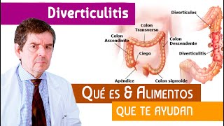 Diverticulitis Qué es amp Alimentos para mejorar esta condición [upl. by Anrehs]