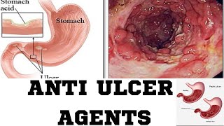 Anti Ulcer AgentsPPIH2 RECEPTOR ANTAGONISAMHARIC TUTORIAL [upl. by Naeerb]