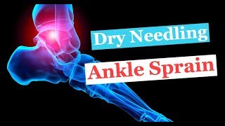 DRY NEEDLING and muscle work for Acute Ankle Sprain with knee pain [upl. by Gilburt]