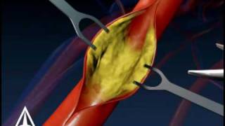 Carotid Endarectomy  3D Medical Animation [upl. by Kcinom]