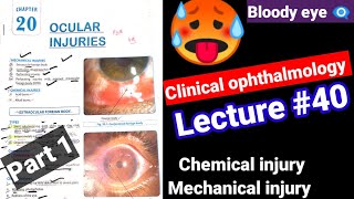 🔴Clinical ophthalmology lectures 40 ocular injuriesmechanicalchemical injury Contusion Hypema [upl. by Airekal]