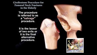 Girdlestone Procedure Hip Fractures Elderly  Everything You Need To Know  Dr Nabil Ebraheim [upl. by Paulsen]