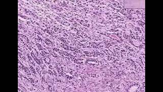 Histopathology StomachAdenocarcinoma [upl. by Daza]