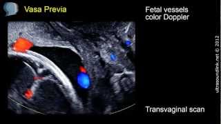 Vasa Previa  ultrasound diagnosis [upl. by Katey538]