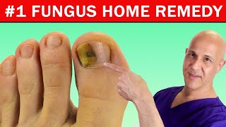 1 Best Home Remedy Cure for Toenail Fungus Dr Mandell [upl. by Eiramac]