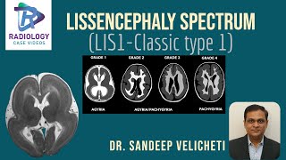 Lissencephaly SpectrumClassic Type1Sandeep VelichetIunderstanding lissencephaly microscopic level [upl. by Eedyah941]