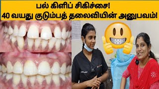 எத்து பல்லுக்கு மெட்டல் கிளிப் சிகிச்சை Forward teeth braces treatment before and after [upl. by Eniawtna]