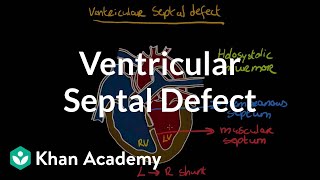 Ventricular septal defect  Circulatory System and Disease  NCLEXRN  Khan Academy [upl. by Ggerk437]