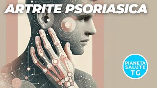 Artrite psoriasica Sintomi Diagnosi e Trattamenti Innovativi [upl. by Ylra]