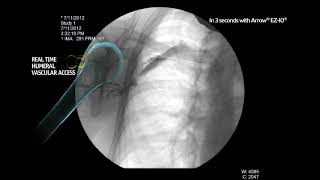 Arrow® EZIO® System  Proximal Humerus Infusion Fluoroscopy Adult Alert Patient [upl. by Lienahs565]