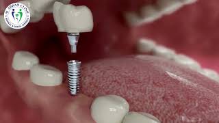 Dental Implant in Dubai [upl. by Nnylaehs756]