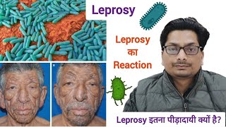 Lepromatous Leprosy  Leprosy का Reaction  Leprosy इतना पीड़ादायी क्यों है Hansens Disease कुष्ट [upl. by Lebama152]