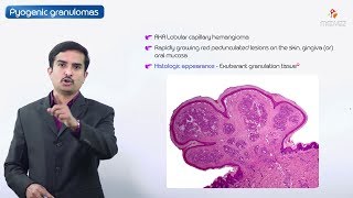 Hemangiomas Usmle step 1  Epidemiology Pathology Clinical features Diagnosis Treatment [upl. by Bernardo561]