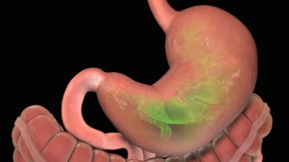 Stomach Ulcer  Nucleus Health [upl. by Attenehs]