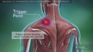 Myofascial pain syndrome and trigger points Reasons [upl. by Ianteen]