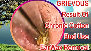 GRIEVOUS Result Of Chronic Cotton Bud Use Ear Wax Removal [upl. by Aleunam685]