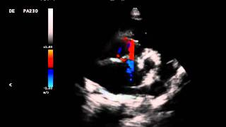 Comunicão Interatrial em Cão com Insuficiência Mitral [upl. by Eiramoj]