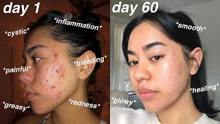 I CLEARED MY ACNE 60 days using Differin Gel Adapalene 01  pictures [upl. by Franci]