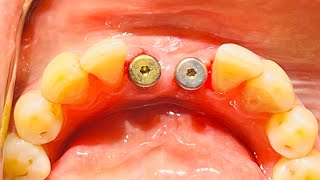 Guided Implant Surgery with 31 41 Neodent Straumann Dental Implant [upl. by Hoem]