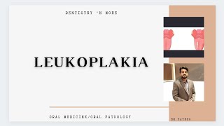 LEUKOPLAKIA [upl. by Ramirolg]