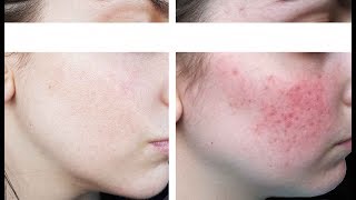 Tout sur ma Rosacée  Kératose pilaire  Session Laser  Dr Charbonneau [upl. by Leifeste]