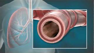 Animation of Bronchial Thermoplasty BT with the Alair® System [upl. by Linnell]