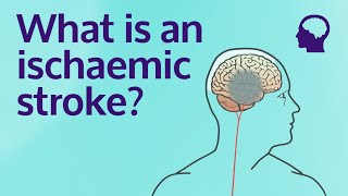 What is an ischaemic stroke [upl. by Thirza]